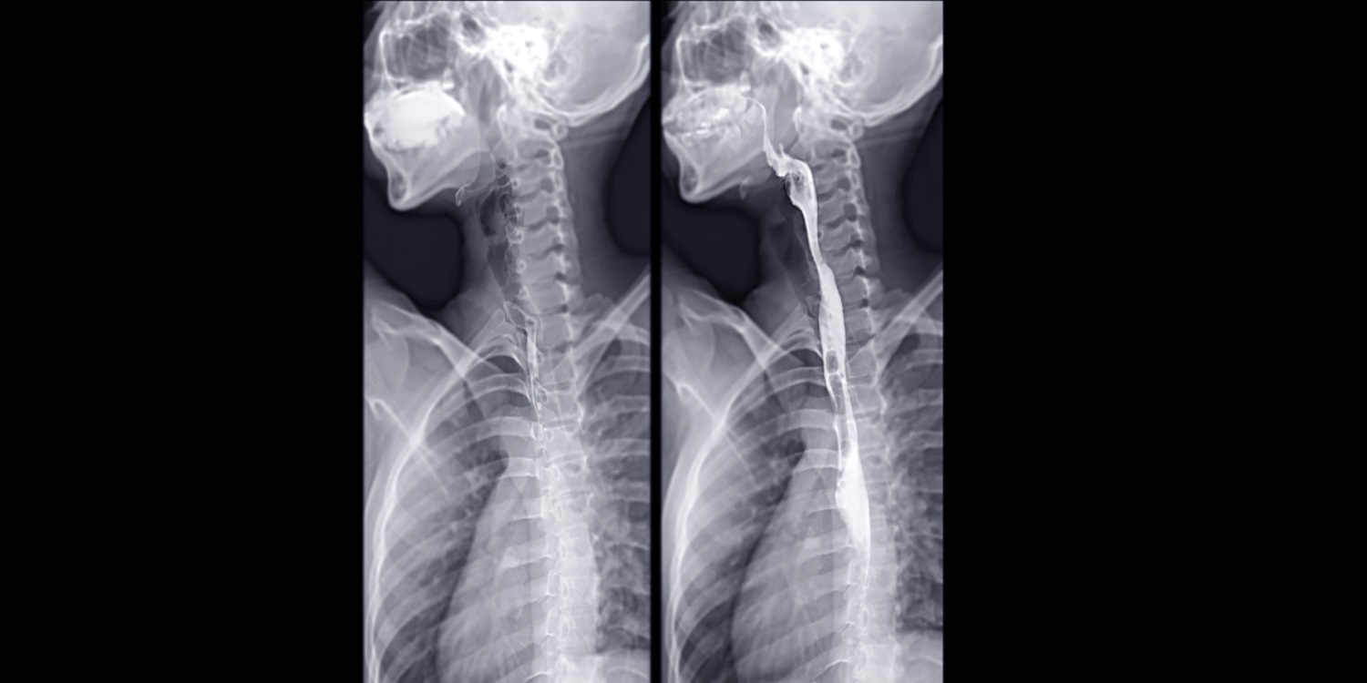 3. Making the Most of the Modified Barium Swallow banner image
